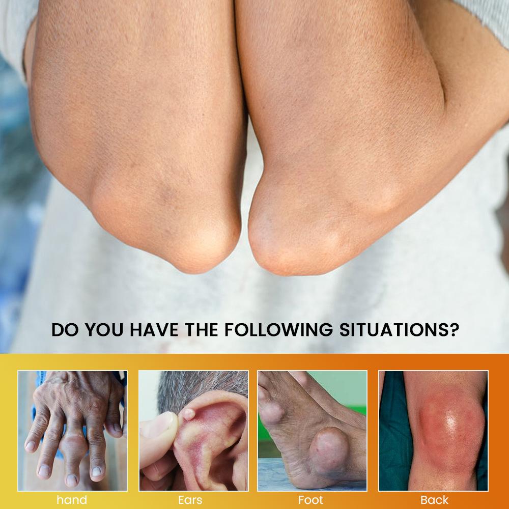 FINALLY!Relief from Gout Pain.Sumifun Gout Relief Balm        Soothes Swollen Joints & Big Toes Fast.joint protection grape seed hydrate eczema  free quantity match butt massage Soothing Magnesium  Conditioning   Firming   mace body neuropathy cream