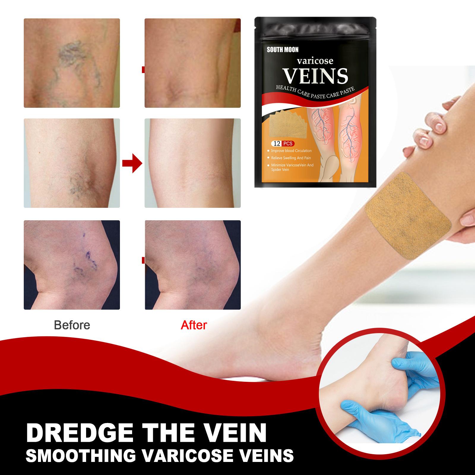 Leg Pain Relief Patch for Varicose Veins, Blood Clots, and Swelling with Cold Compress Treatment Healthcare Therapy Therapeutic Alternative Wellness
