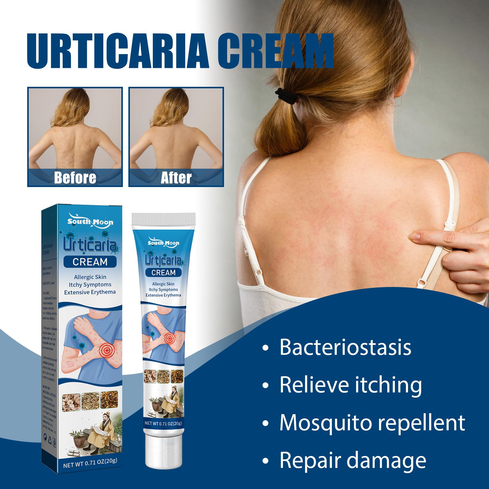 South Moon Urticaria Cream, Topical Ointment For Relieving Pruritus Redness And Repairing Skin