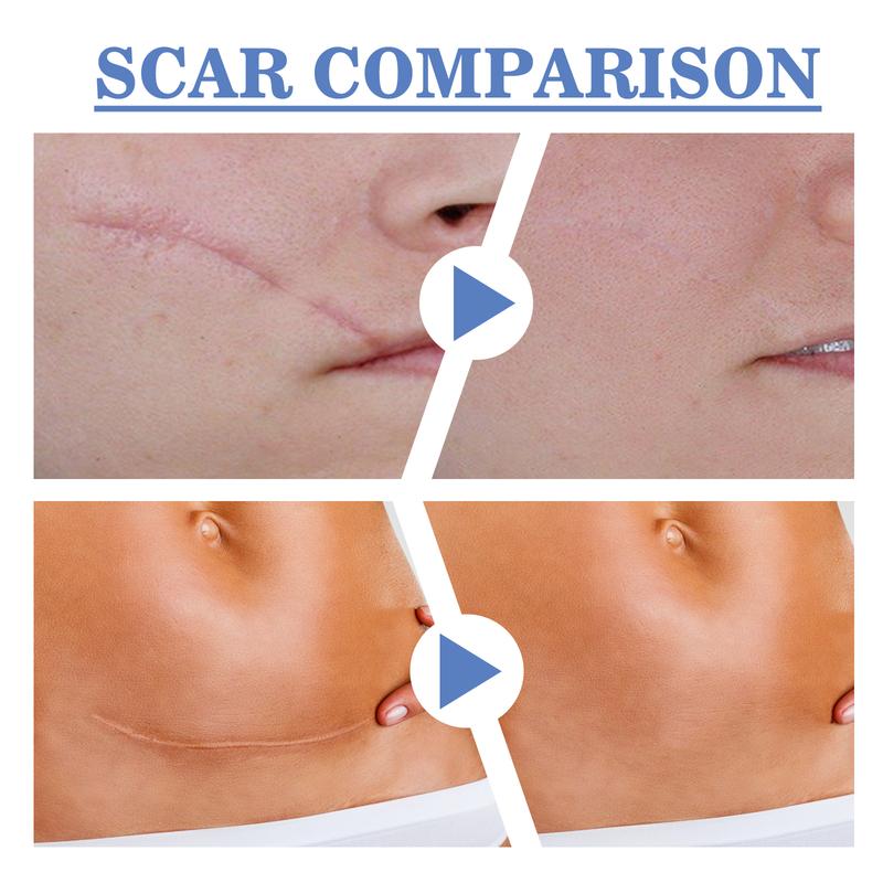 South Moon High Quality Silicone Scar Sheets, Fade Scar Waterproof Breathable Skin Scar Beauty Patch