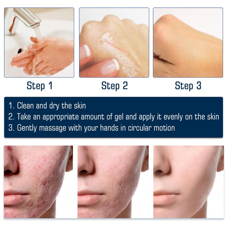 West&Month High-Grade Formula Scar Gel, Scar Repair Surgery Scar Pregnancy Smoothing Skin Care Gel