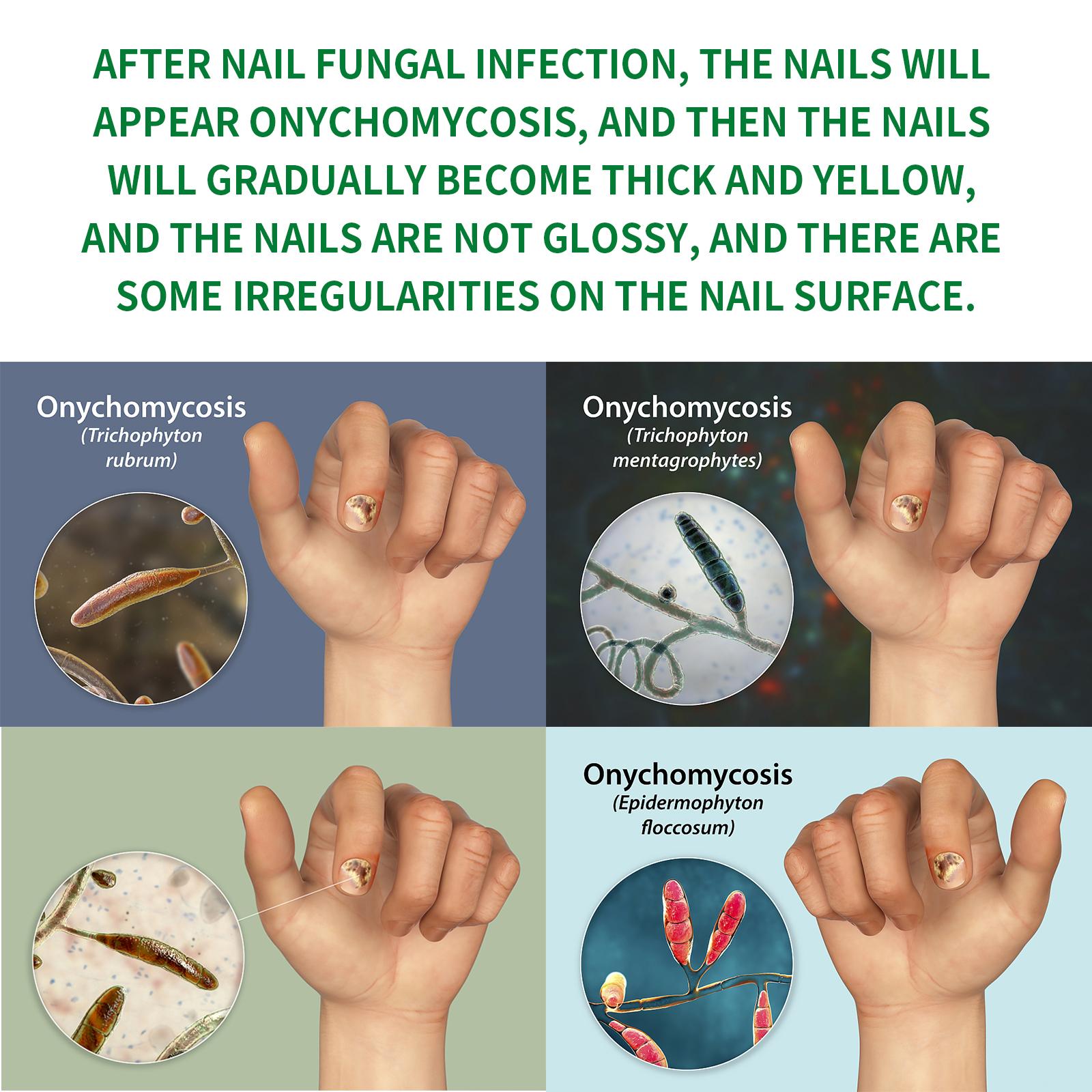 Nail Fungus Treatment, Extra Strength Nail Serum, Triple Action Formula for Damaged Nails Care & Healthy Looking Nails