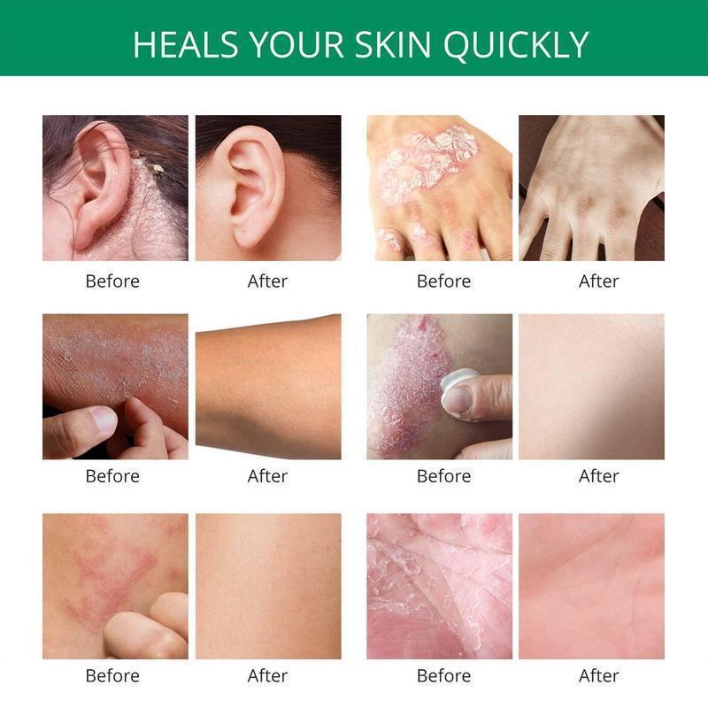 All-Natural Herbal Soothing Cream | Eczema & Psoriasis Relief | Anti-Bacterial Skin Defense | Hydrates Dry, Itchy, Sensitive Skin | Plant-Based Balm for Whole Family | Ancient Formula, 30g | Safe for All Ages | Perfect Christmas/New Year Gifts