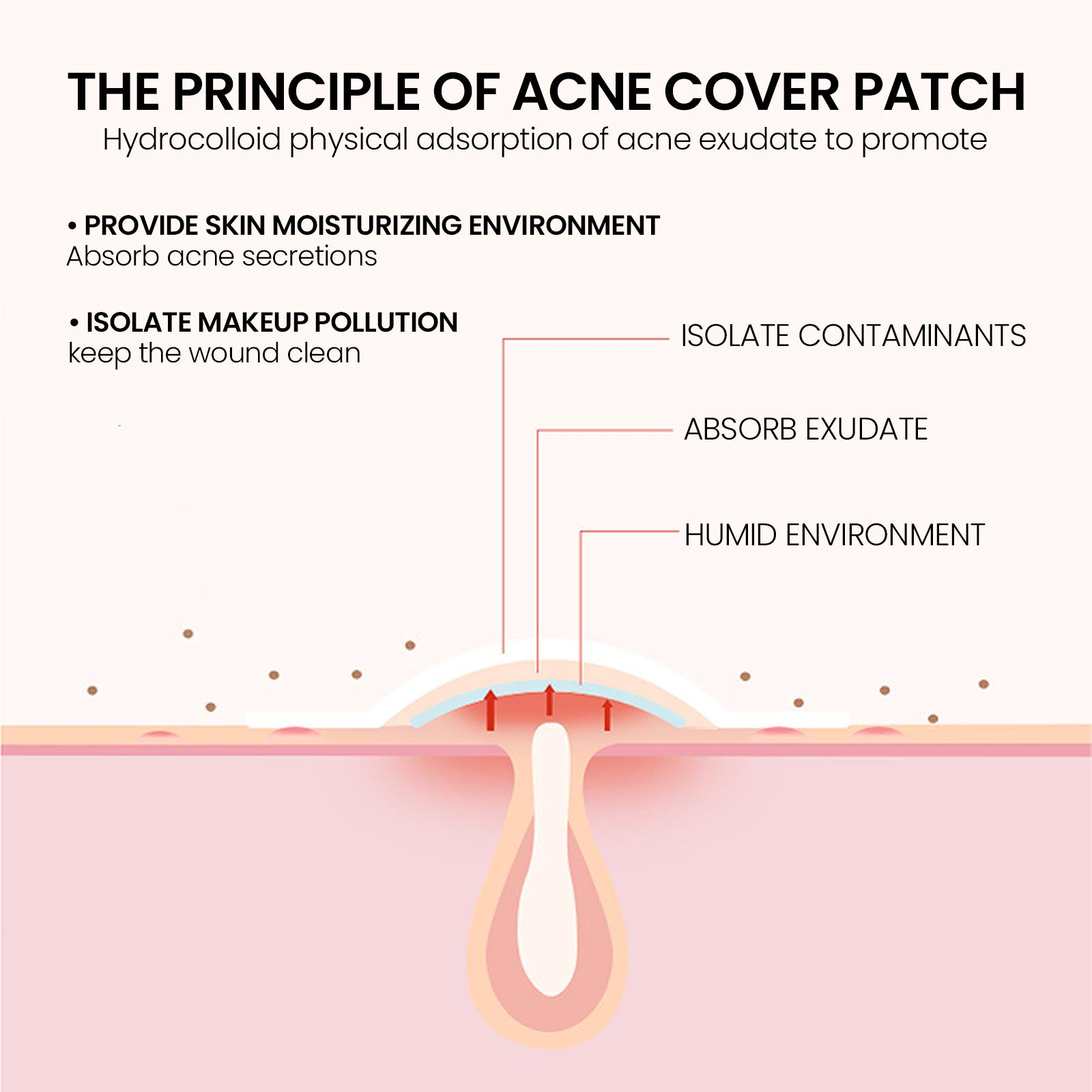 Jaysuing Gentle Acne Pore Cleansing Cover Patches 200pcs Colorful Hydrocolloid Stickers with Tea Tree and Witch Hazel for Blemish Care and Oil Control