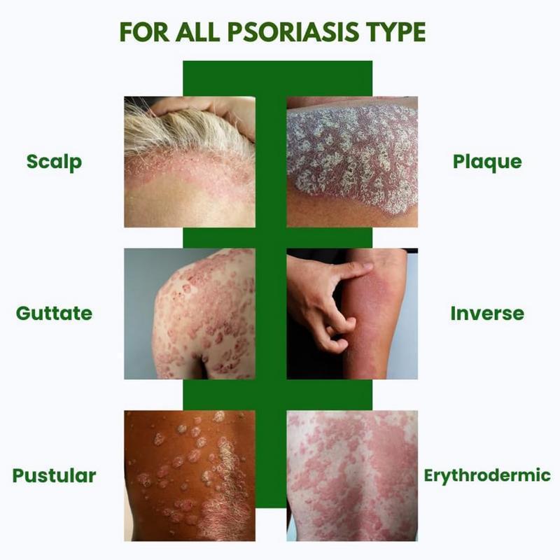 Herbal Soothing Cream for Eczema & Psoriasis Relief | Anti-Bacterial Skin Defense | Hydrates Dry, Itchy, Sensitive Skin | Plant-Based Balm for Whole Family | 30g | Safe for All Ages | Perfect Christmas/New Year Gifts - Healing Remedies Therapy Herbal Soothing Cream for Eczema & Psoriasis Relief | Anti-Bacterial Skin Defense | Hydrates Dry, Itchy, Sensitive Skin | Plant-Based Balm for Whole Family | 30g | Safe for All Ages | Perfect Christmas/New Year Gifts - Healing Remedies Therapy