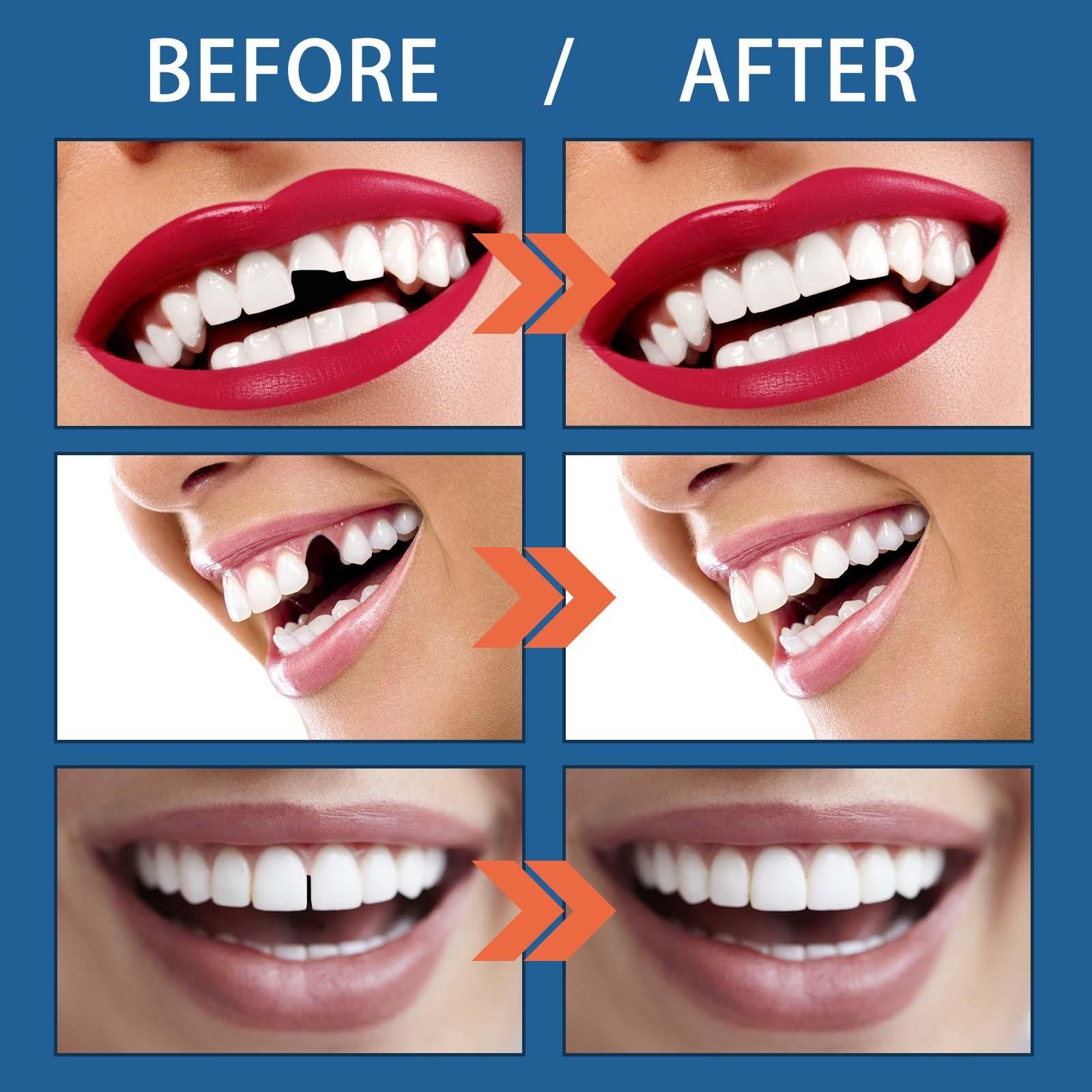 "Fix Teeth Instantly! 25g Dental Repair Kit - Temporary Filling for Cavities & Missing Teeth - Dentist-Approved Formula - From Pain to Relief in Minutes - Order Emergency Kit Now!" "Fix Teeth Instantly! 25g Dental Repair Kit - Temporary Filling for Cavities & Missing Teeth - Dentist-Approved Formula - From Pain to Relief in Minutes - Order Emergency Kit Now!"