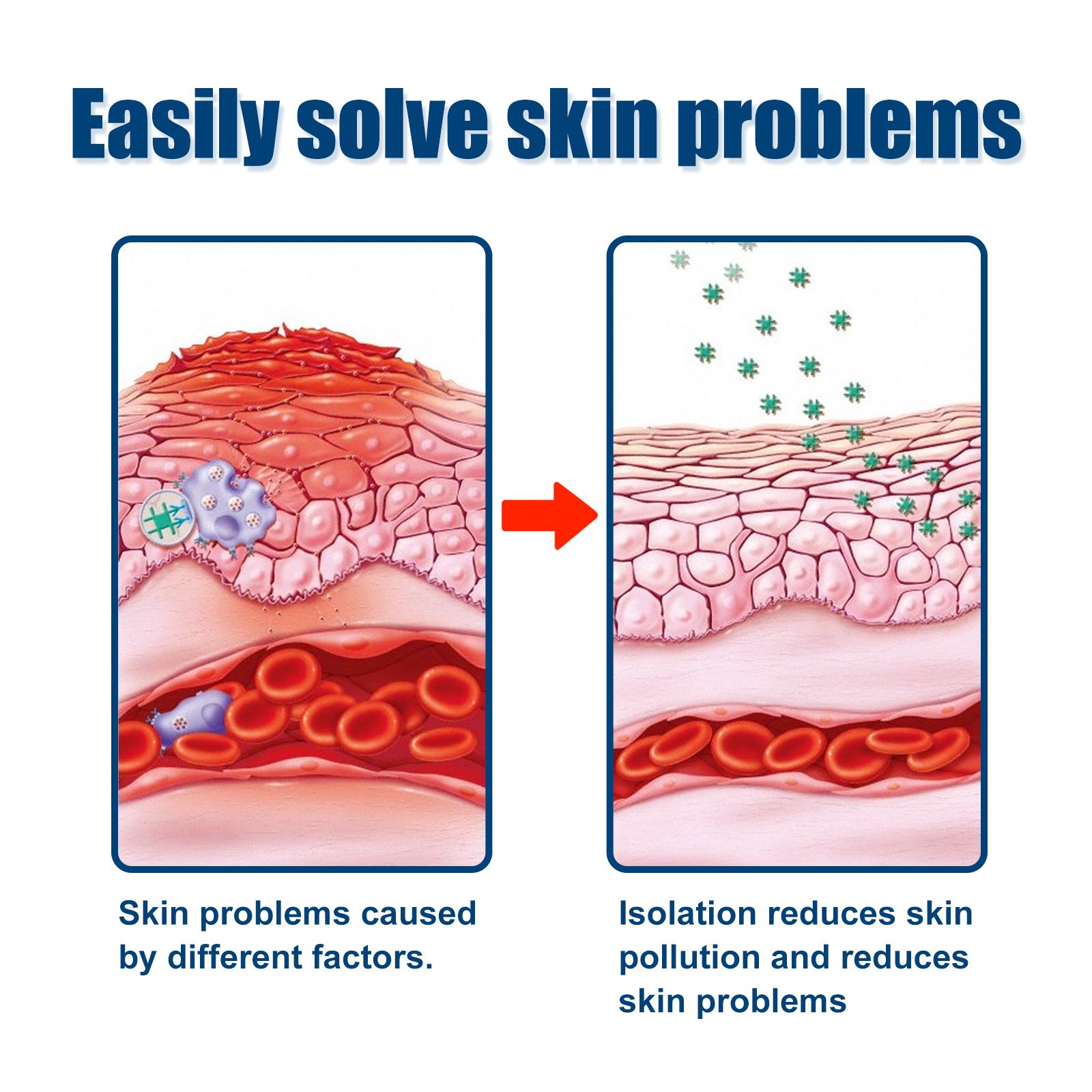 South Moon Urticaria Cream, Topical Ointment For Relieving Pruritus Redness And Repairing Skin