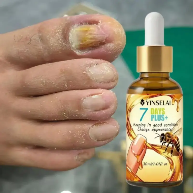 Strong 95% Bee Venom Nail Essence, Infused with Honeycomb and Ginger Juice, Provides 24-Hour Continuous Care, Repairs/Strengthens/Hardens nails