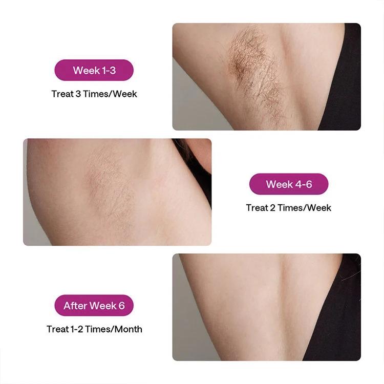 New Trends Dual Pulsed 600nm 72W Sapphire Cooling Freezing Point Hair Remover Laser Hair Removal Instrument IPL Hair Removal New Trends Dual Pulsed 600nm 72W Sapphire Cooling Freezing Point Hair Remover Laser Hair Removal Instrument IPL Hair Removal