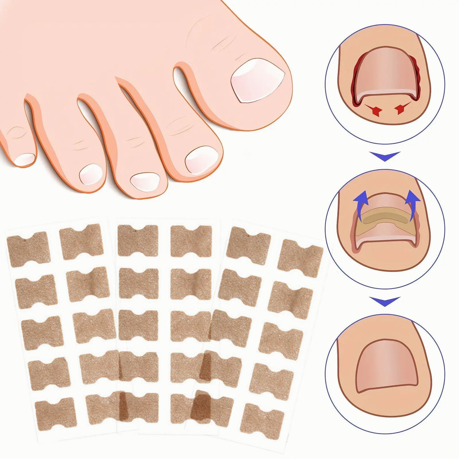 Ingrown Toenail Correction Patch, 30pcs/set Breathable Toe Nail Correction Strip, Professional Pedicure Tool for Home & Beauty Salon Use