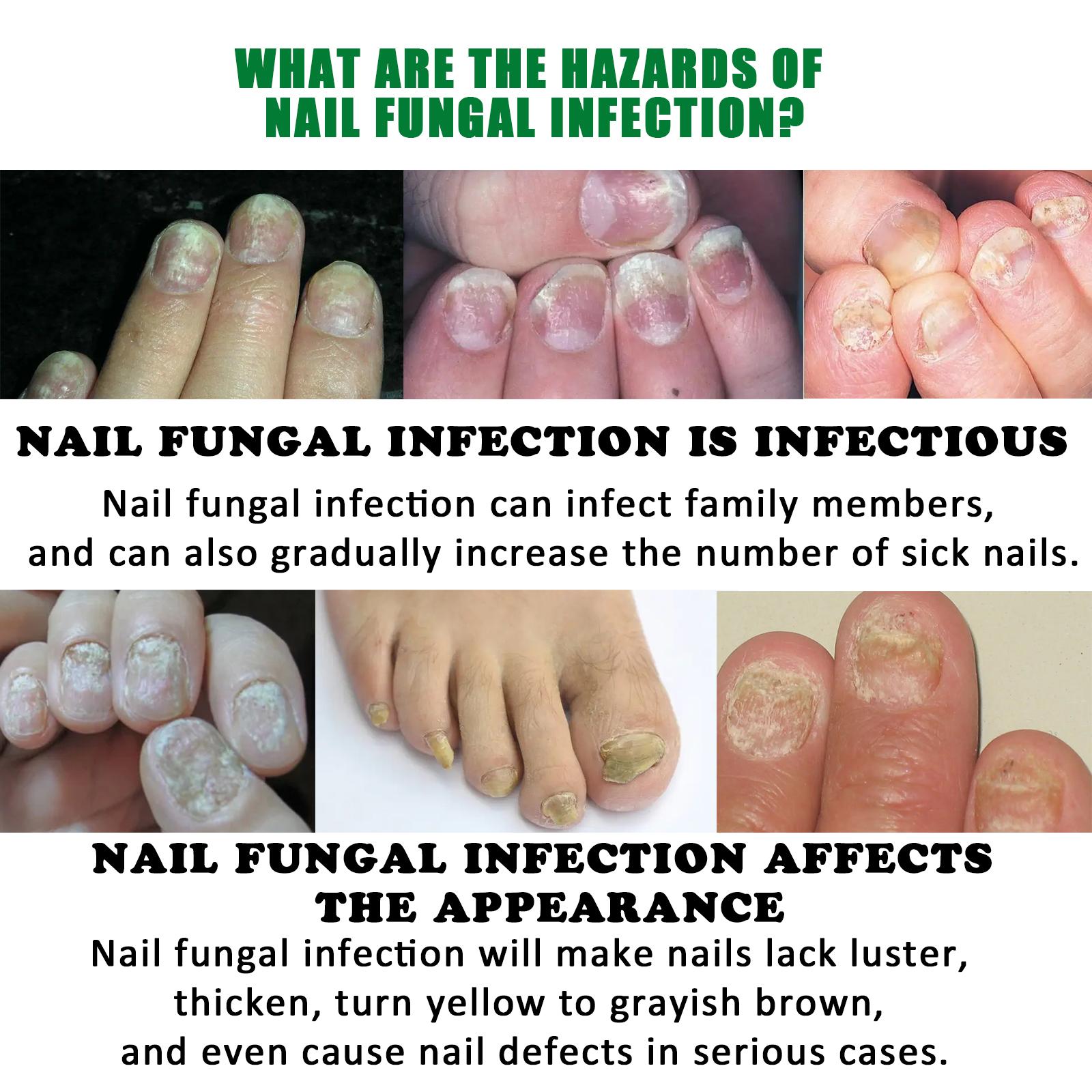 Nail Fungus Treatment, Extra Strength Nail Serum, Triple Action Formula for Damaged Nails Care & Healthy Looking Nails Nail Fungus Treatment, Extra Strength Nail Serum, Triple Action Formula for Damaged Nails Care & Healthy Looking Nails