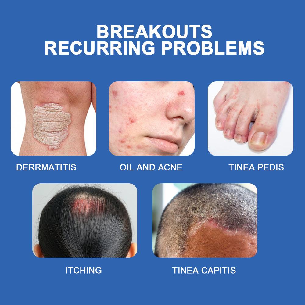 Sumifun antibacterial antipruritic cream, tea tree essential oil + natural formula, can cure tinea capitis and fungus Treatment Antifungal