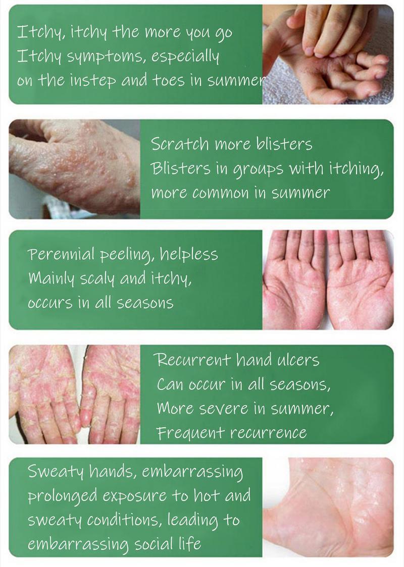 All-Natural Herbal Soothing Cream | Eczema & Psoriasis Relief | Anti-Bacterial Skin Defense | Hydrates Dry, Itchy, Sensitive Skin | Plant-Based Balm for Whole Family | Ancient Formula, 30g | Safe for All Ages | Perfect Christmas/New Year Gifts