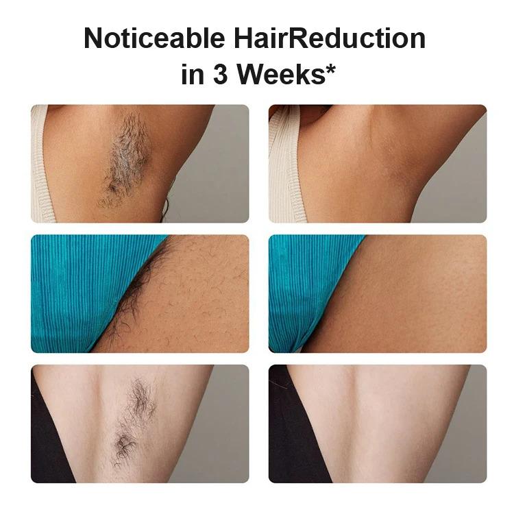 New Trends Dual Pulsed 600nm 72W Sapphire Cooling Freezing Point Hair Remover Laser Hair Removal Instrument IPL Hair Removal