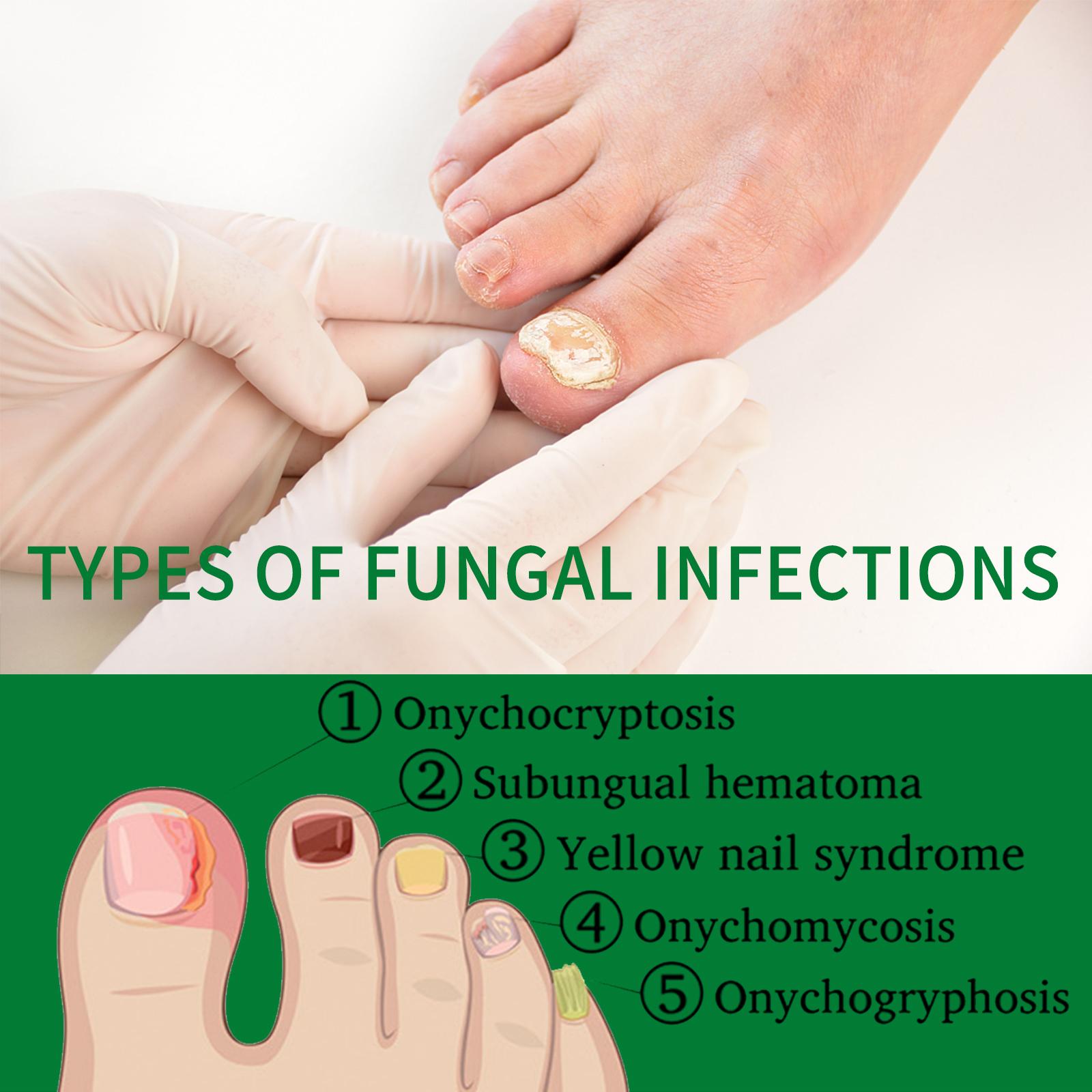 Nail Fungus Treatment, Extra Strength Nail Serum, Triple Action Formula for Damaged Nails Care & Healthy Looking Nails